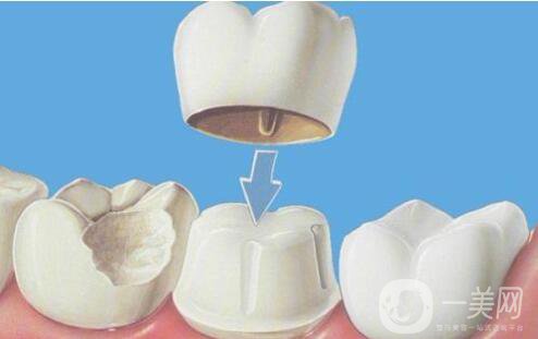 全烤瓷牙套多少錢一顆 全烤瓷牙套好不好