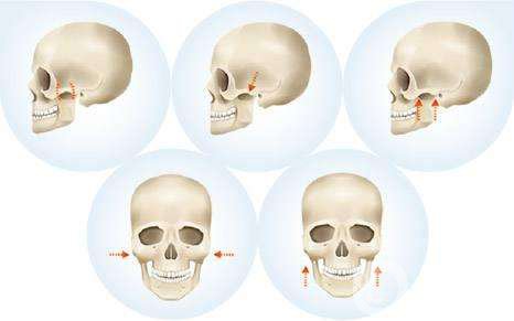 顴骨顴弓整形多久恢復(fù) 顴骨顴弓注意事項(xiàng)