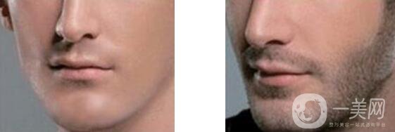 廣州胡須種植怎么樣 廣州胡須種植恢復(fù)時(shí)間