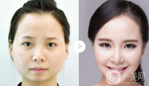 三個驚人的小竅門 可以使整形手術(shù)恢復(fù)得更快