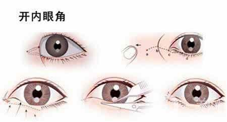 開眼角的風險大嗎 開眼角*果好不好