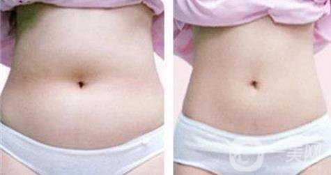 腹部吸脂的費用,腹部吸脂注意事項