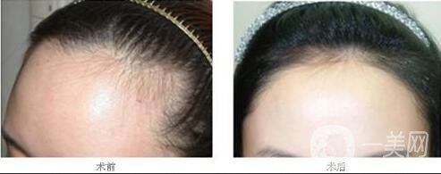 發(fā)際線種植手術(shù)價格,發(fā)際線種植術(shù)后護理