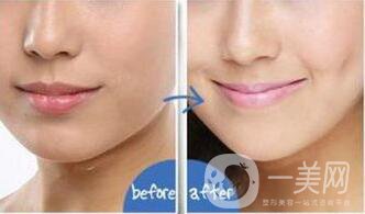 人造酒窩前后照片,人造酒窩多少錢