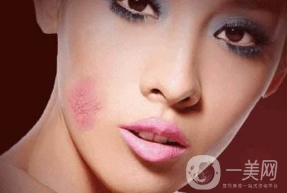 去紅色胎記大概多少錢 去紅色胎記費用