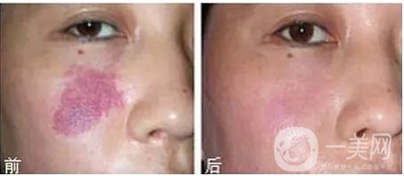 去紅色胎記大概多少錢 去紅色胎記費用