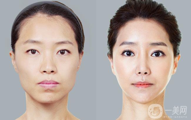 什么是臉頰美容手術(shù) 美容*果怎么樣