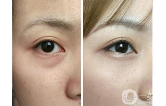 造成下眼皮松弛的原因 下眼皮松弛需要做手術(shù)嗎