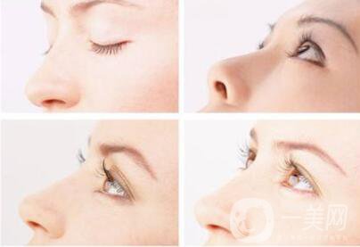 朝天鼻矯正價格 朝天鼻形成的原因