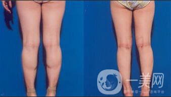 20歲可以小腿吸脂嗎,20歲怎么瘦腿