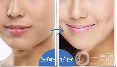 酒窩整形價(jià)格,酒窩整形多久恢復(fù)