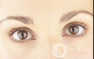 埋線雙眼皮*果圖