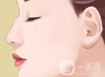 駝峰鼻手術(shù)價格一般是多少？