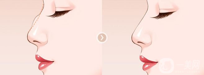 駝峰鼻手術(shù)價格一般是多少？