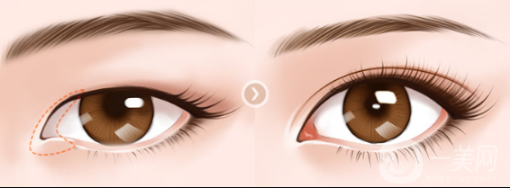 開眼角的*果怎么樣 好不好？