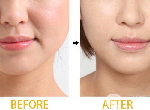 自體脂肪填充鼻唇溝怎么樣 能保持多久？