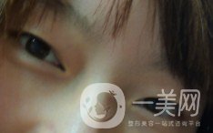 上海九院張波醫(yī)生好不好？醫(yī)生雙眼皮案例附照片