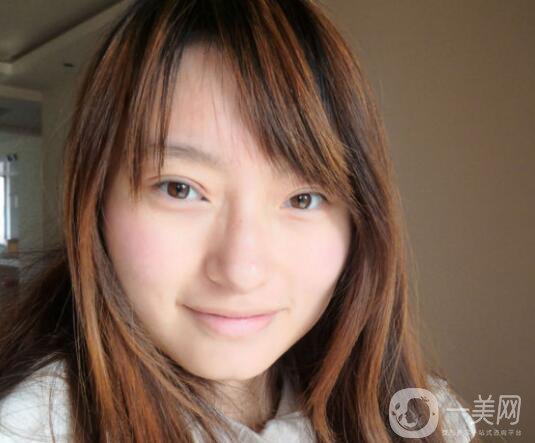 上海九院張波醫(yī)生好不好？醫(yī)生雙眼皮案例附照片