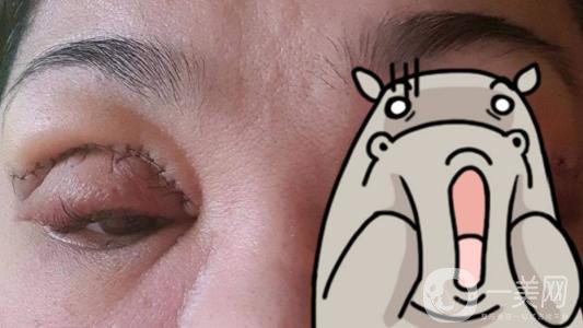 上海九院張波醫(yī)生好不好？醫(yī)生雙眼皮案例附照片