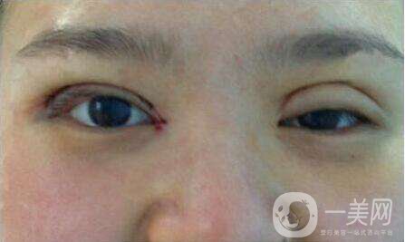 上海九院張波醫(yī)生好不好？醫(yī)生雙眼皮案例附照片