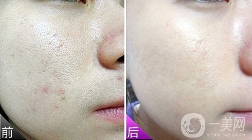 微針祛痘*果好嗎 微針祛痘多久恢復(fù)正常