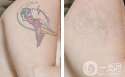 正常黑紋身洗幾次合適 洗紋身手術*嗎