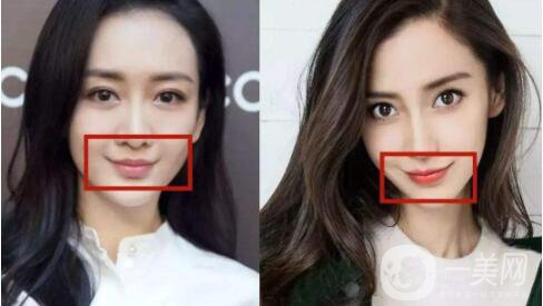 什么是微笑提升手術(shù) 持續(xù)時(shí)間是多久