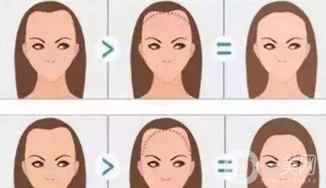 FUT毛發(fā)移植是和什么人做 功*是什么