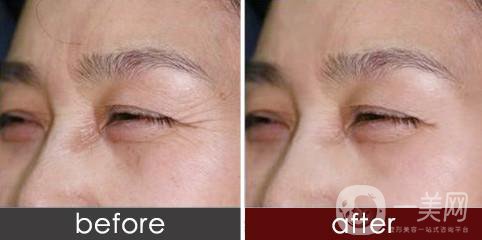 眼角除皺手術(shù)多少錢 眼角除皺的方法