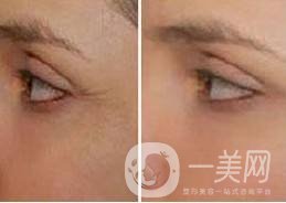 眼角除皺手術(shù)多少錢 眼角除皺的方法