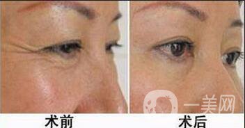 伊維蘭面部除皺,*果維持多久