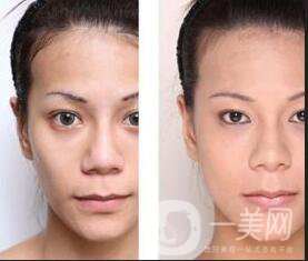 上海玻尿酸豐眉弓,價(jià)格貴不貴