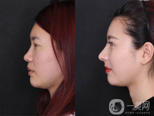 注射隆鼻價(jià)錢一般是多少?