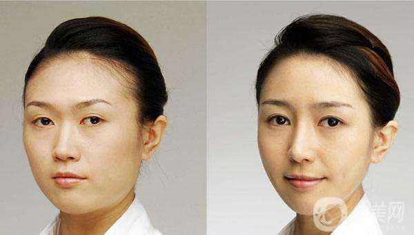 開眼角*果*嗎？開眼角前后照片