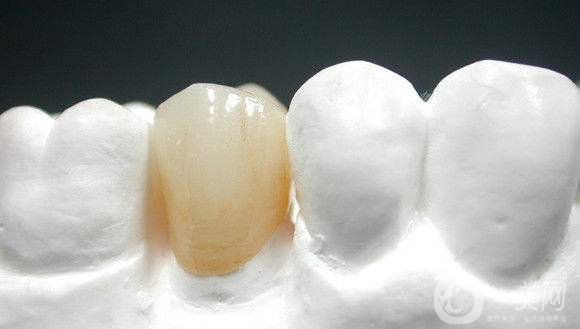 烤瓷牙一般要多少錢 貴不貴？