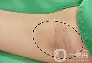 腋臭手術(shù)多久恢復(fù) 術(shù)后何如護(hù)理