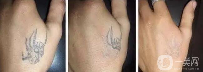 激光洗紋身能洗干凈嗎 多久消腫呢