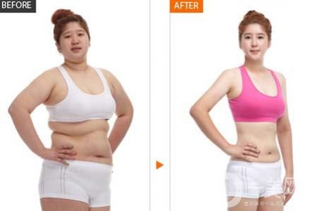 冷凍減肥一次多少錢 冷凍減肥價格