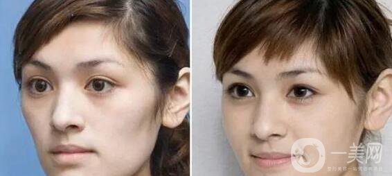 玻尿酸豐臥蠶會下垂嗎 *果好不好