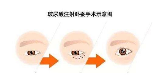 玻尿酸打臥蠶多久消腫 術(shù)后怎么護(hù)理好