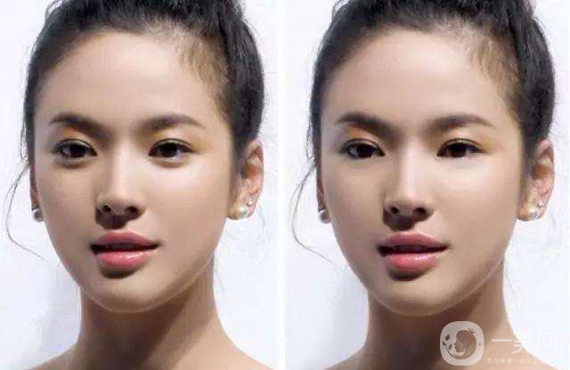 玻尿酸豐臥蠶后遺癥 恢復(fù)時間是多久