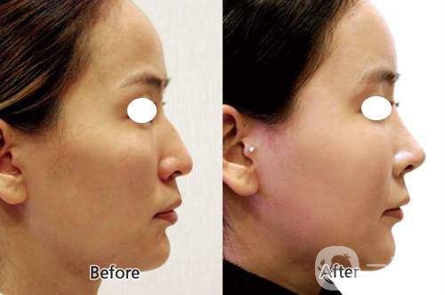 透明質(zhì)酸有副作用嗎 透明質(zhì)酸的功*有哪些