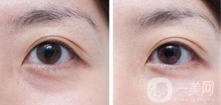 淚溝填充消腫時間