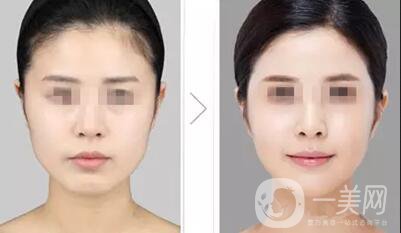 削骨手術(shù)親身經(jīng)歷