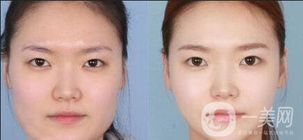 磨骨手術(shù)后遺癥,磨骨手術(shù)危害