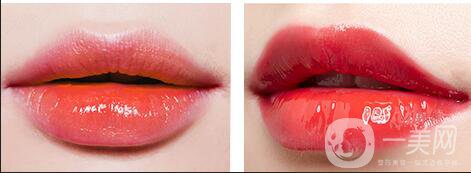 玻尿酸豐唇注意事項