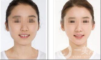 激光溶脂瘦臉會(huì)反彈嗎,激光溶脂瘦臉多少錢