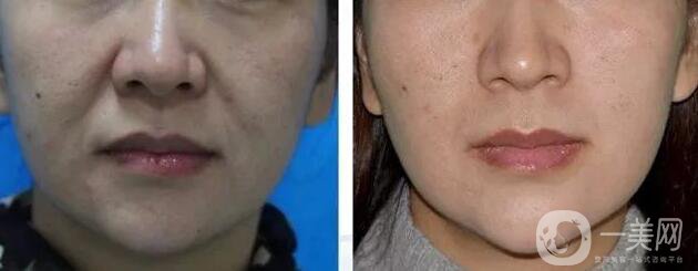 等離子激光溶脂價格