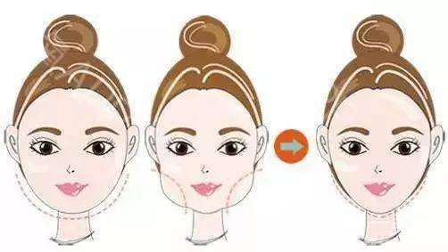 臉部光纖溶脂價格 臉部光纖溶脂的作用