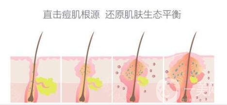 紅藍(lán)光祛痘印多少錢(qián) 紅藍(lán)光祛痘印貴嗎